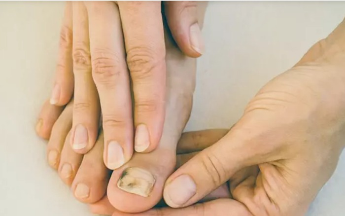 Xuất hiện vệt nâu dưới móng chân 3