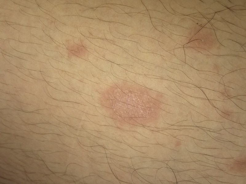 xuat-hien-vet-tron-bi-noi-dom-do-tren-da-va-ngua-la-do-dau 4