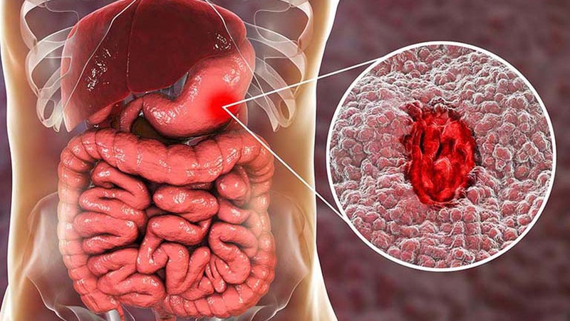 xuat-huyet-da-day-non-ra-mau-co-nguy-hiem-khong-1 Cropped.jpg