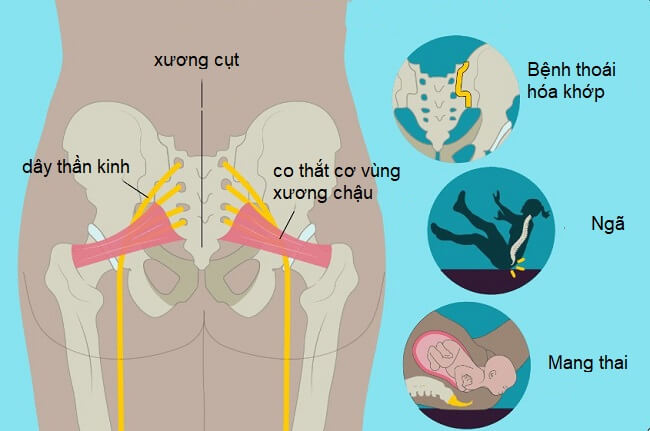Xương cụt nằm ở đâu và có vai trò gì? Thông tin về bệnh lý tại xương cụt 3