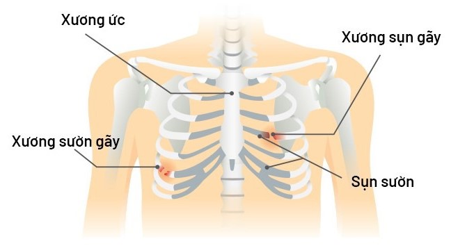 Xương sườn: Vị trí, cấu tạo, chức năng và một số bệnh lý thường gặp 4