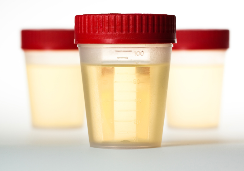 Ý nghĩa về bảng màu nước tiểu của trẻ sơ sinh​ 2