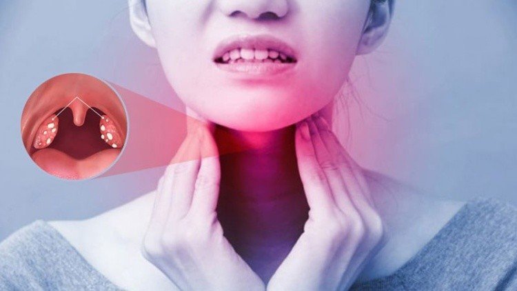 Đau họng khạc ra máu: Dấu hiệu cảnh báo một số bệnh lý 4